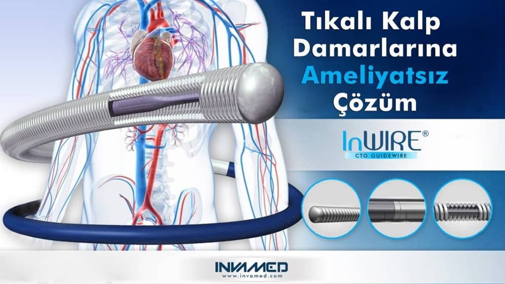 Dikkat! Tam tıkalı kalp damarlarına ameliyatsız çözüm